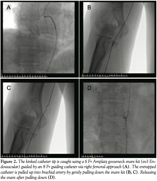 Entrapment of a Kinked Catheter in the Radial Artery During Transradial Coronary Angiography